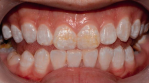 fluorosis