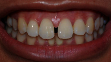 Diastema